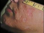 MRSA Vicitm Speaks Out About Settlement