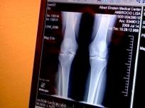New Knees for Lisa