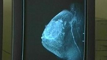 Why Some Women Are Opting for Mastectomies