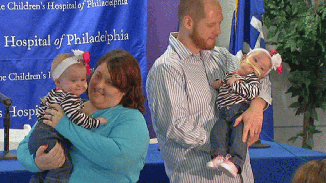 Formerly Conjoined Twins Make Debut