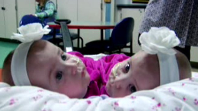 Conjoined twin baby girls from New York are recovering after being separated at Children's Hospital of Philadelphia. NBC10's Dawn Timmeney talks about what could be next for the girls.