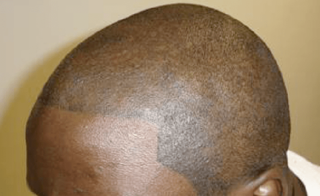 Going Bald? Get Your Head Tattooed