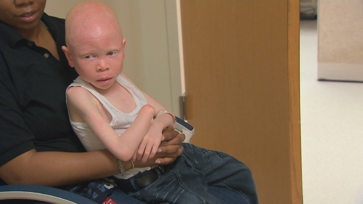 Child-With-Albinism.jpg