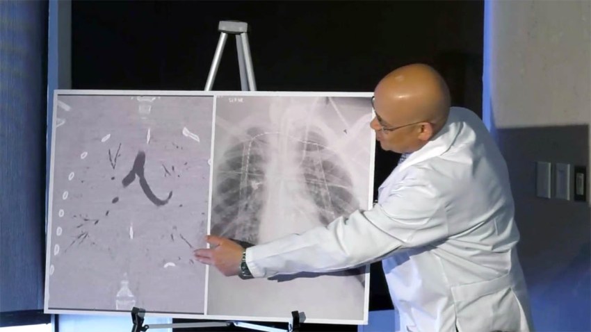 111219 Vaping Lung Transplant NATL
