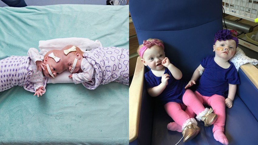Formerly Conjoined Twins Doing Well Months After Successful Surgery At Chop Nbc10 Philadelphia