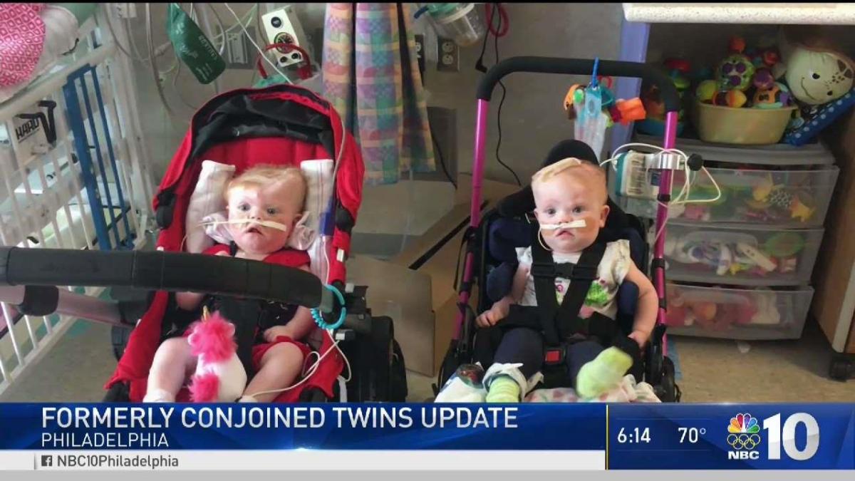 Formerly Conjoined Twins Recovering Months After Surgery Nbc10 Philadelphia 8409