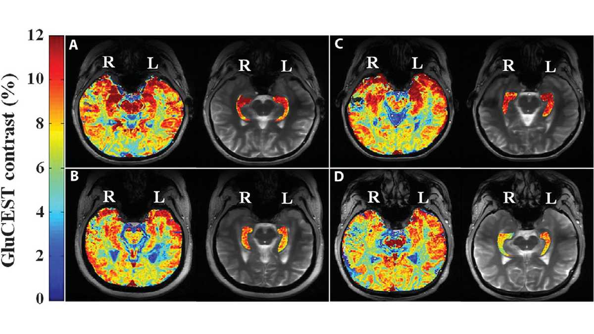 new research on epilepsy