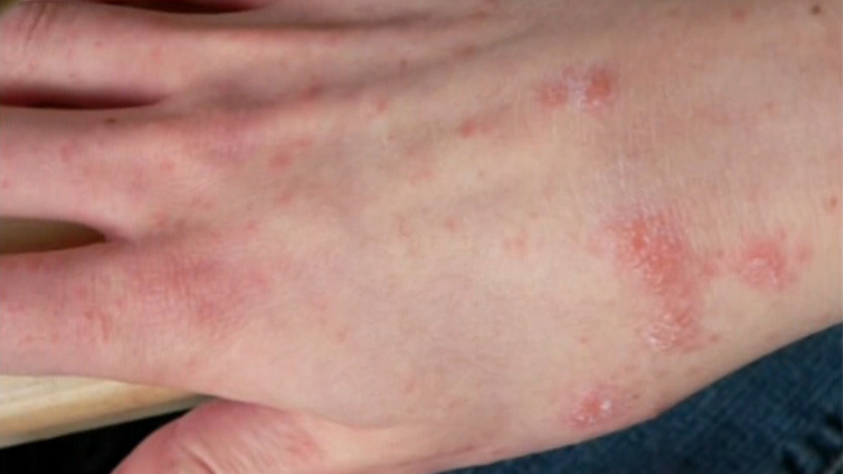 18 Students in Radnor School District Diagnosed With Scabies NBC10