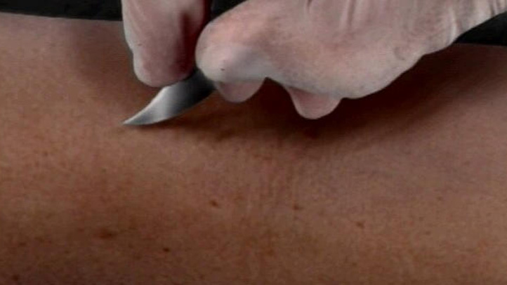 Scalpel Generic