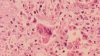 Health department warns of possible measles exposure at Philly airport