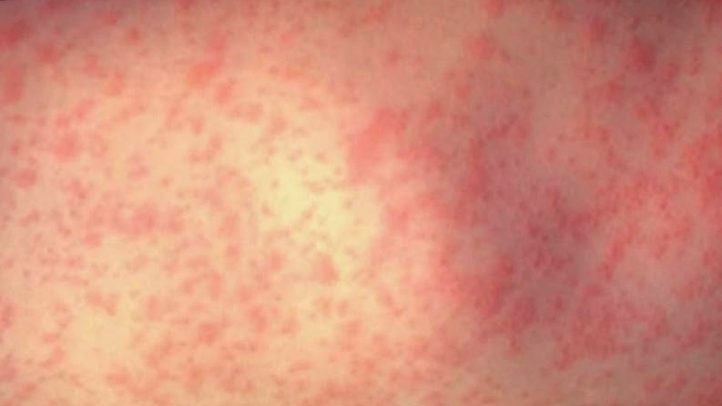 measles040511_722x406
