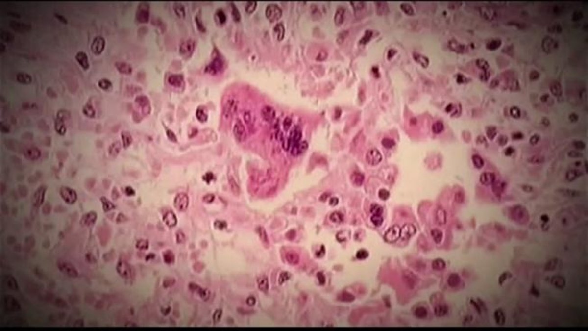 Possible measles exposure in Wilmington, Del., officials say – NBC10 Philadelphia - Vimarsana News