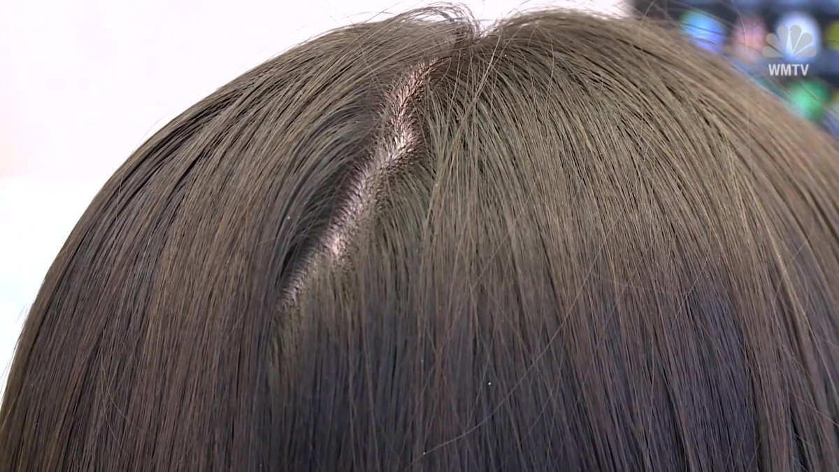 What Causes COVID-Related Hair Loss? – NBC10 Philadelphia