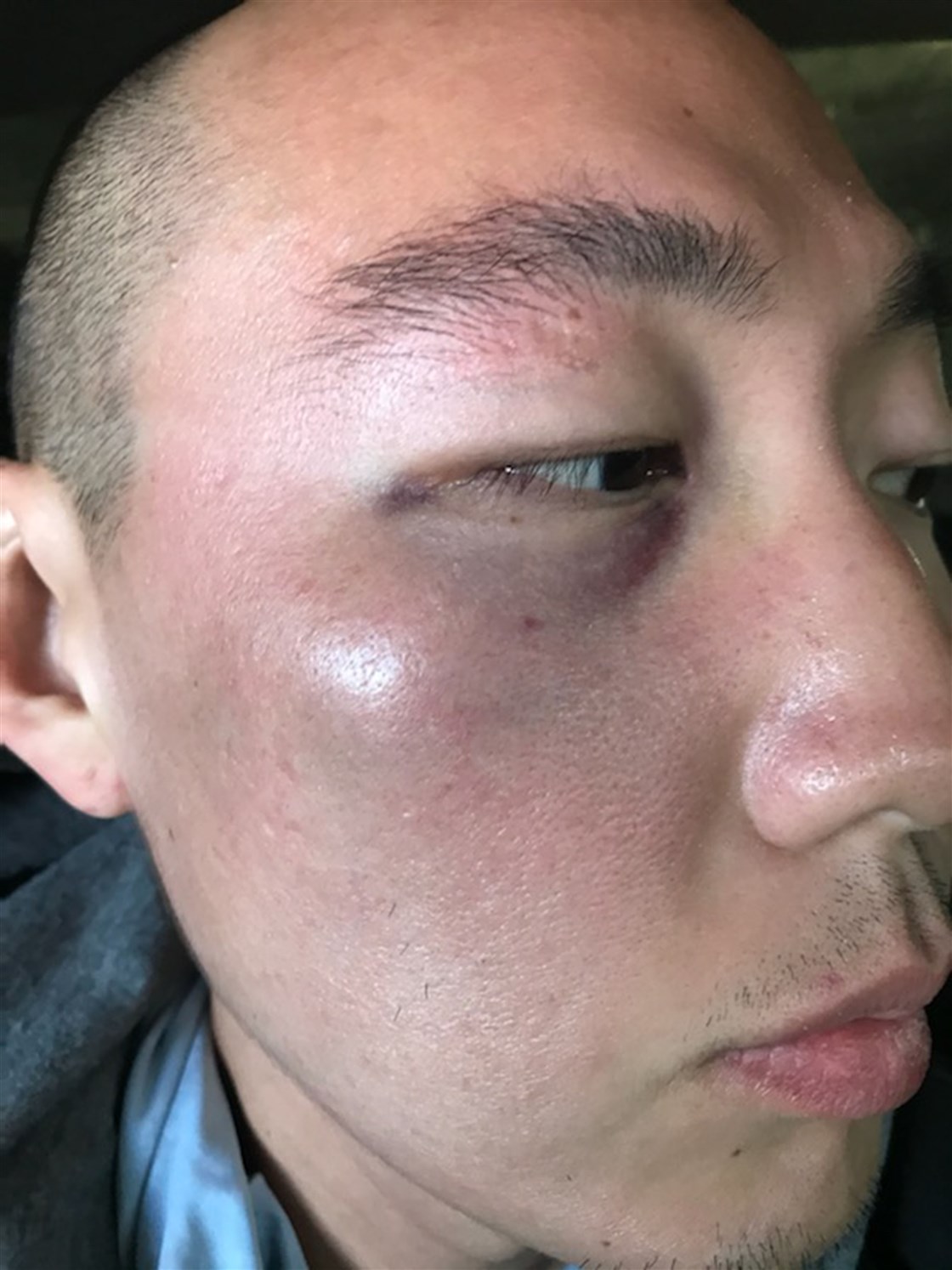 Denny Kim's injury from attack