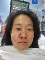 Nasu suffered multiple facial injuries after the attack, including three fractures in her nose, one cheek fracture and broken teeth.