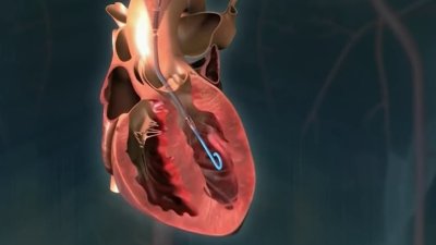 Medical Breakthrough Reduces Risk of Heart Surgery