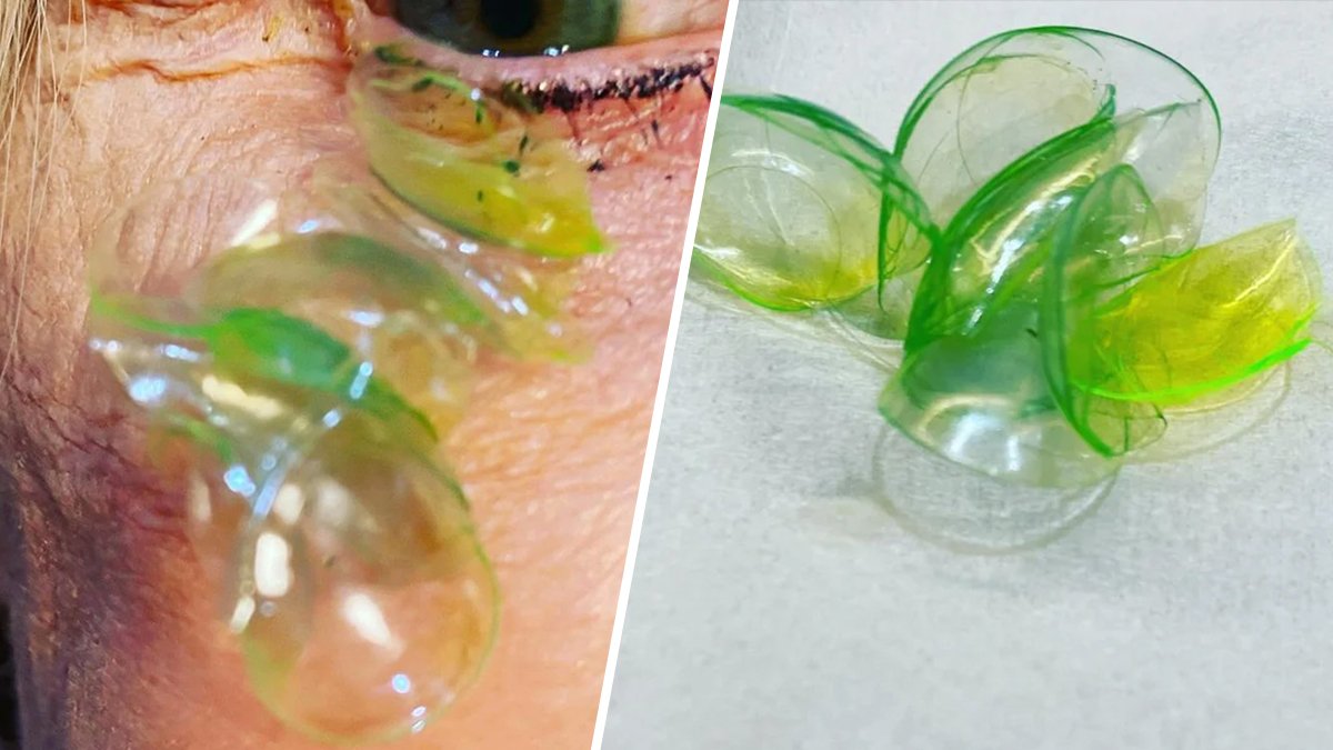 Woman Had 23 Contact Lenses Stuck Under Her Eyelid, Doctor Says – NBC10 Philadelphia - Vimarsana News