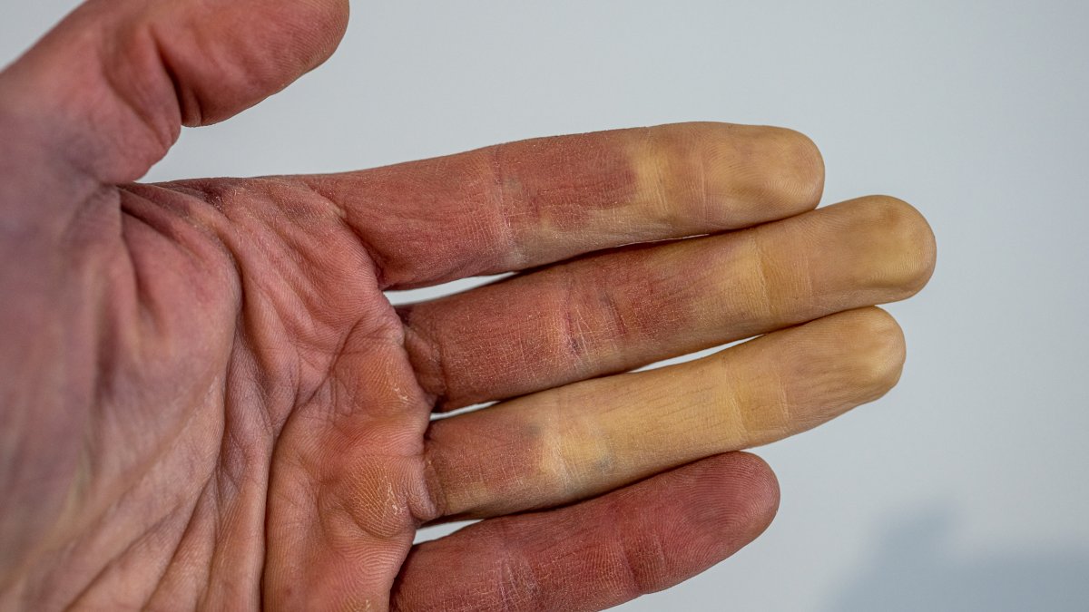 What Is Raynaud's Disease? – NBC10 Philadelphia - Vimarsana News