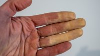 What Is Raynaud's Disease? Disorder Causes White or Blue Fingers, Toes When It's Cold