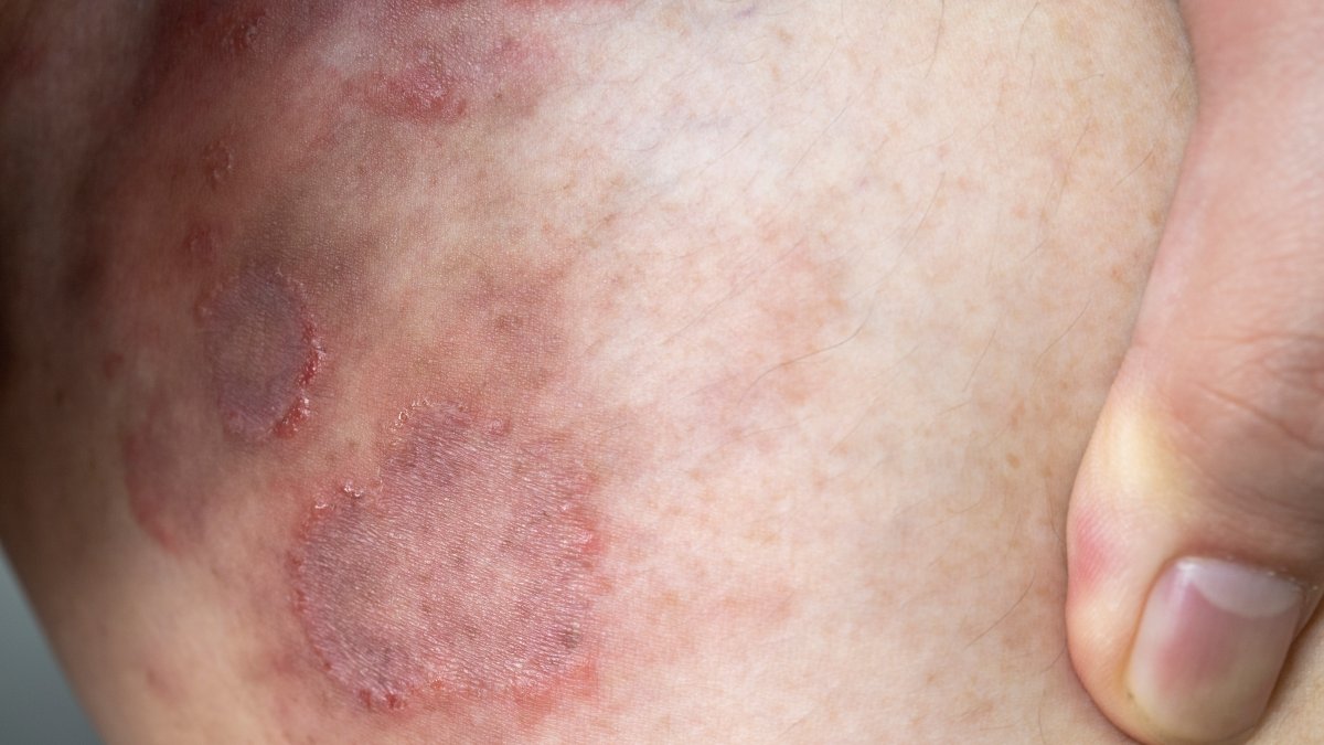 First Resistant Ringworm Infections Detected in United States – NBC10 Philadelphia - Vimarsana News