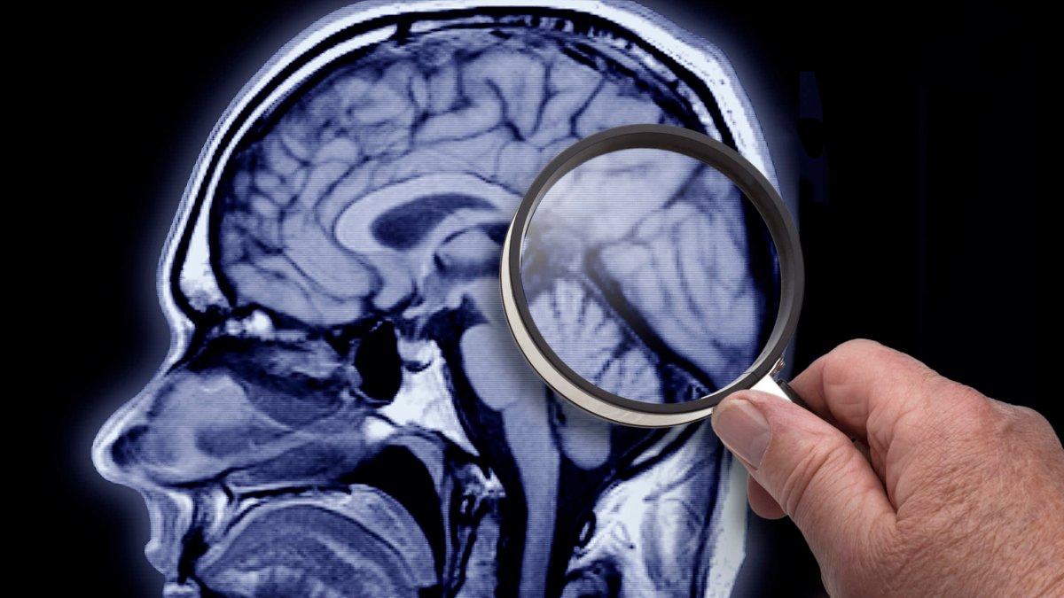 Health insurance companies may not cover new Alzheimer's drug Leqembi – NBC10 Philadelphia - Vimarsana News
