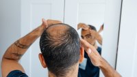 Skin moles that grow hair may offer a potential treatment for baldness, a study in mice suggests