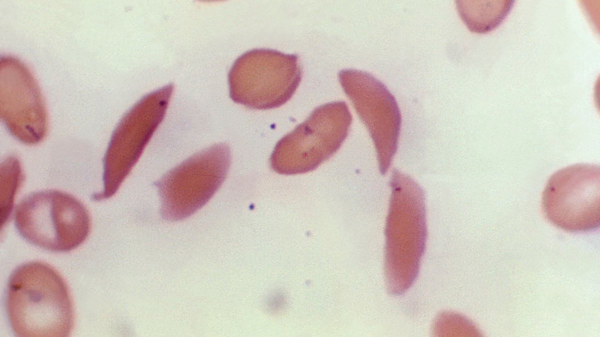 FDA approves first CRISPRbased treatment for sickle cell disease