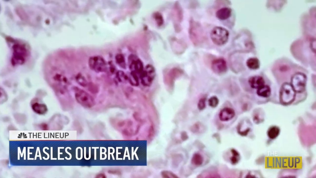 Measles fears amid Philly outbreak The Lineup NBC10 Philadelphia