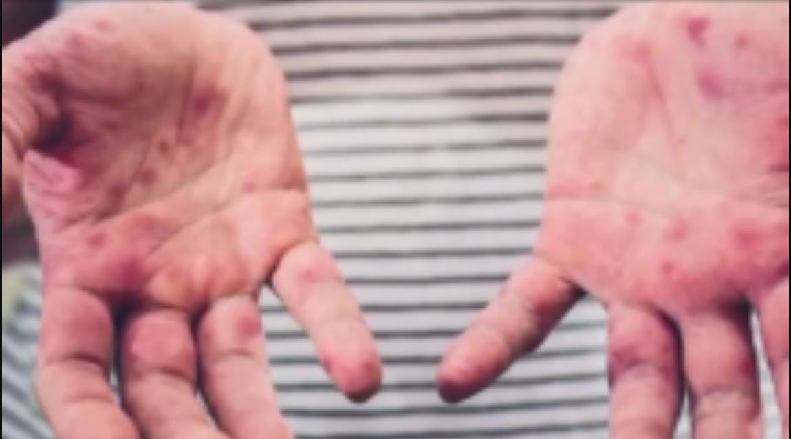 Officials warn of possible measles exposure at Montgomery County urgent care