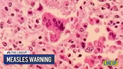 Measles warning in Philly, Montco: The Lineup