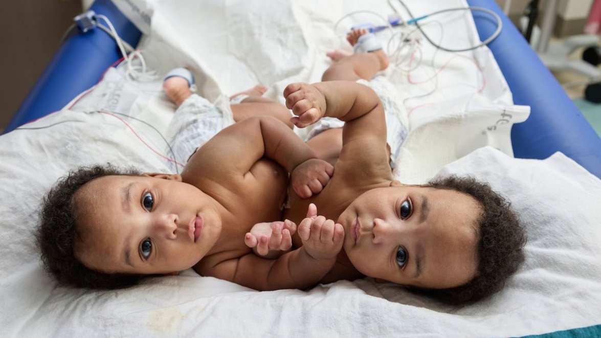 CHOP surgeons successfully separate conjoined twin boys – NBC10 ...
