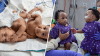 CHOP surgeons successfully separate conjoined twin boys after 8-hour surgery