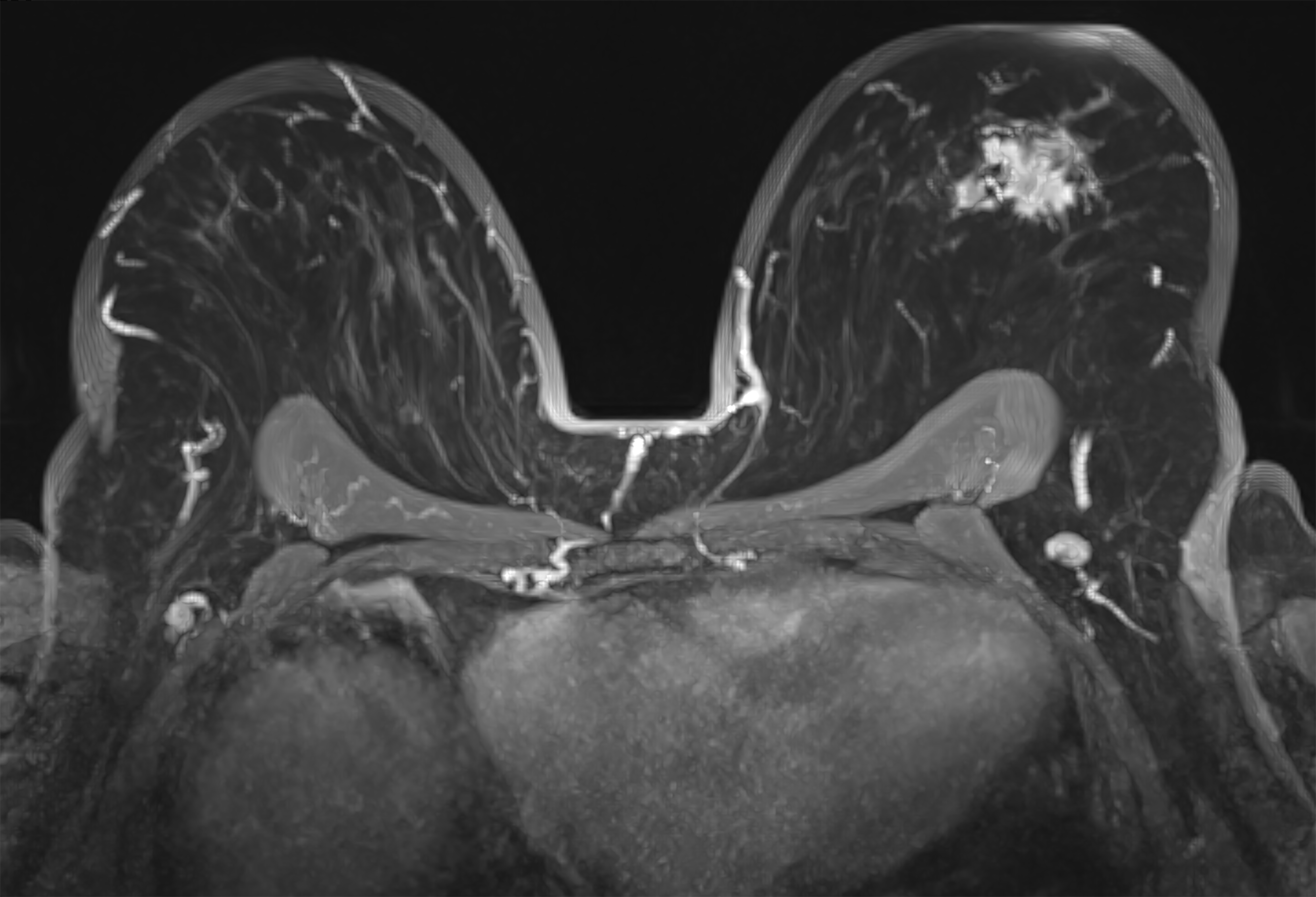 Breast MRI is mainly used for women who have been diagnosed with breast cancer