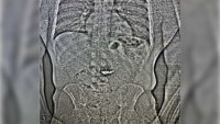This image provided by the Orlando Police Department shows an x-ray of what are believed to be two diamond earrings that were stolen from a Tiffany & Co. jewelry store in central Florida and were swallowed by the suspect. ( Orlando Police Department office via AP)
