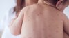 Delaware officials find 2nd measles case after man tests positive in Kent County