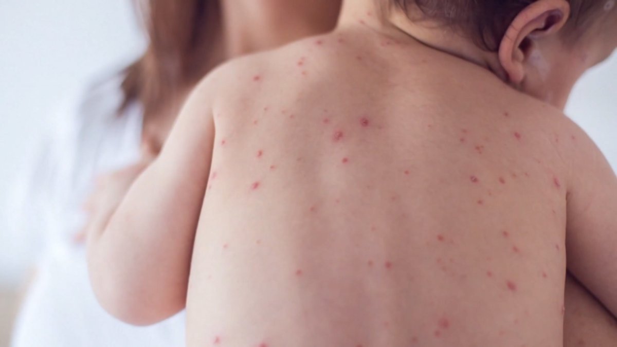 What you need to know about the MMR vaccine – NBC10 Philadelphia