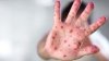 Chester County measles cases expected to increase as officials urge vaccination