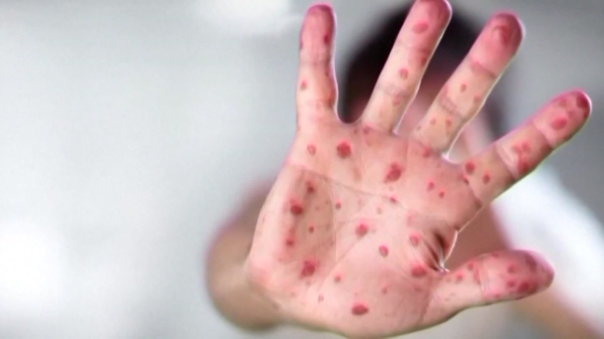Chester County measles cases expected to increase as officials urge vaccination