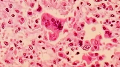 CDC urging travelers to be vaccinated against measles