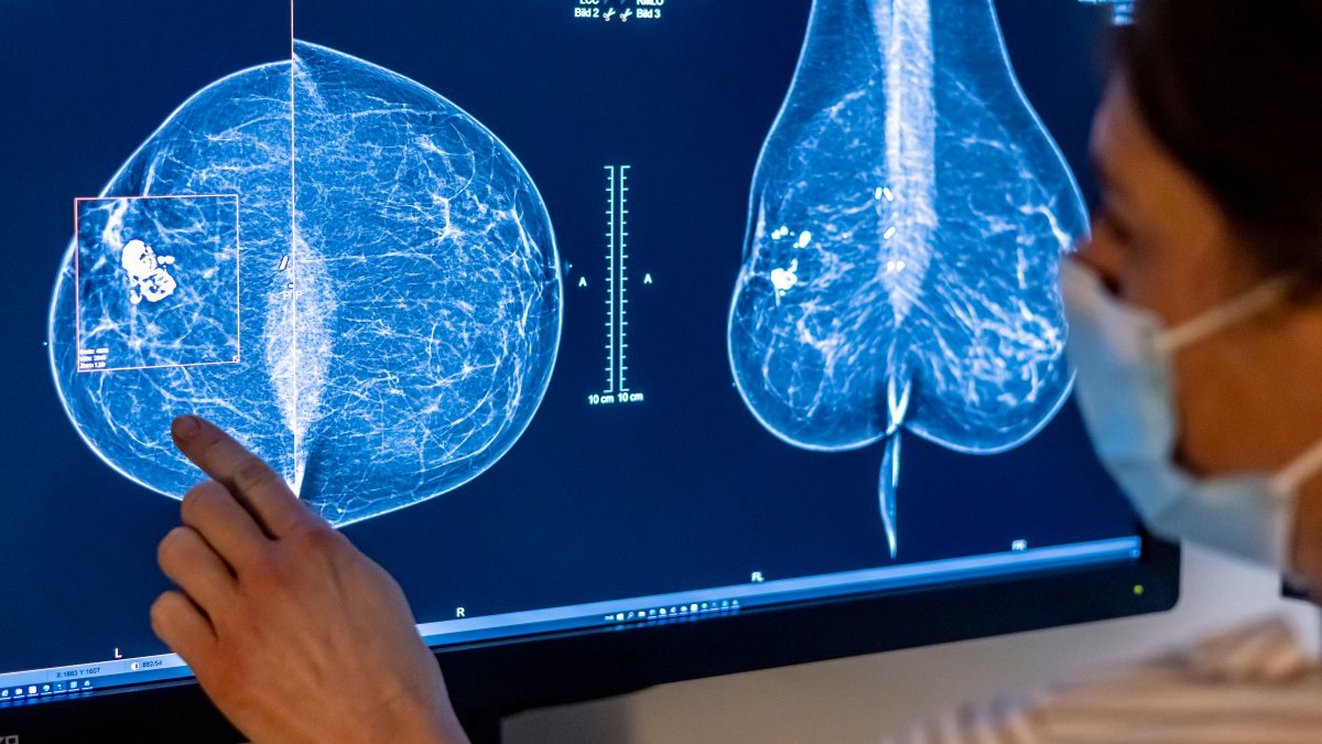 AI Advances Enhance Early Breast Cancer Detection, Risk Prediction