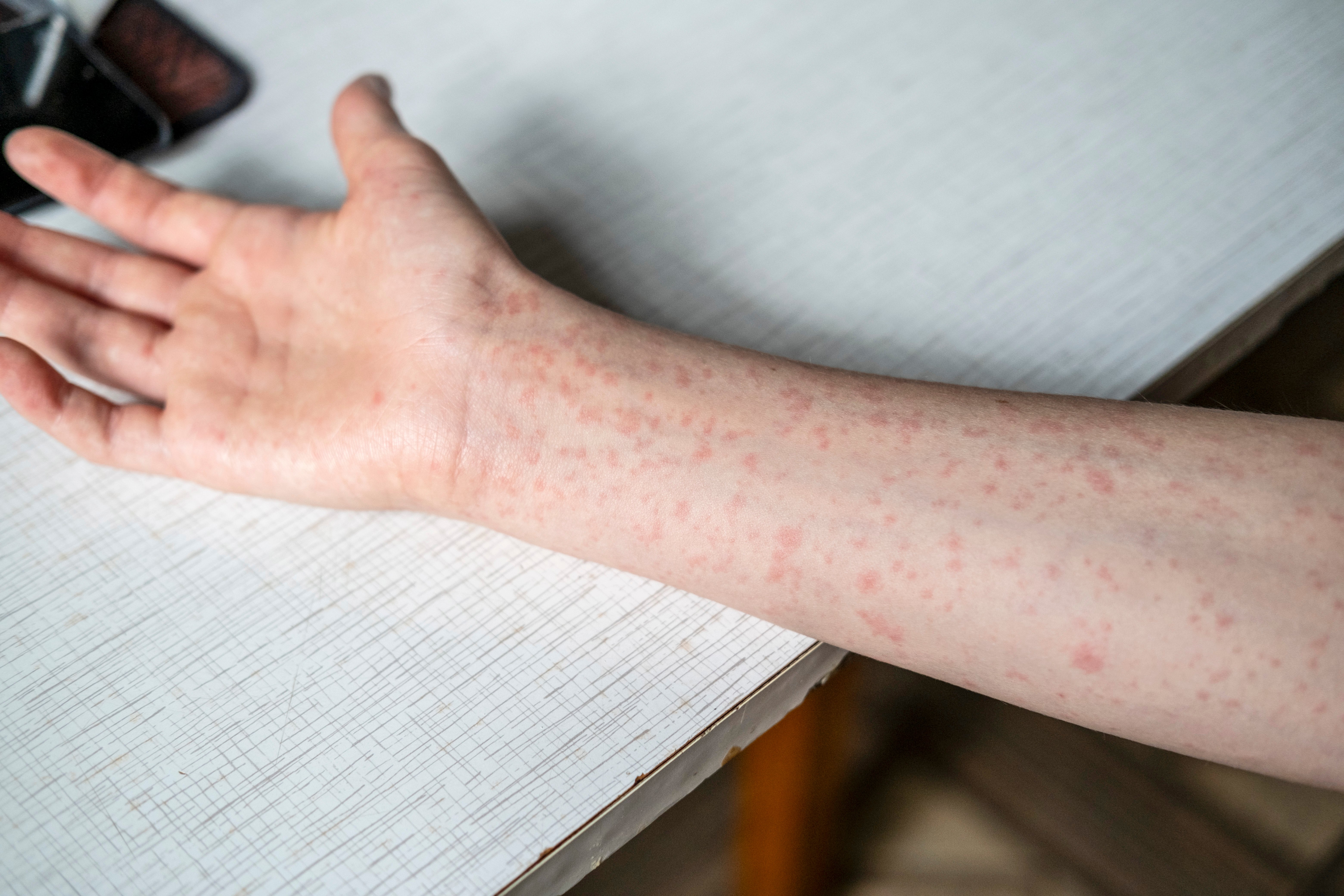 Delaware declares measles outbreak after 4 confirmed cases