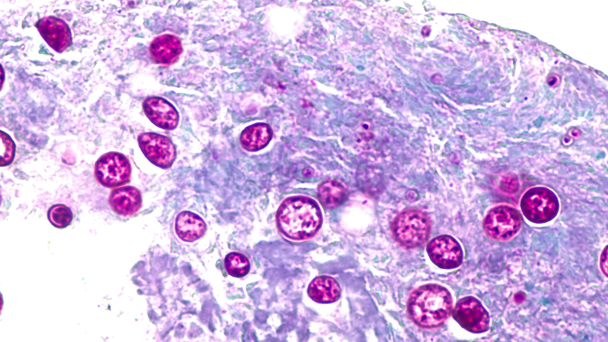 Cyclosporiasis outbreaks: What to know about the foodborne illness and symptoms