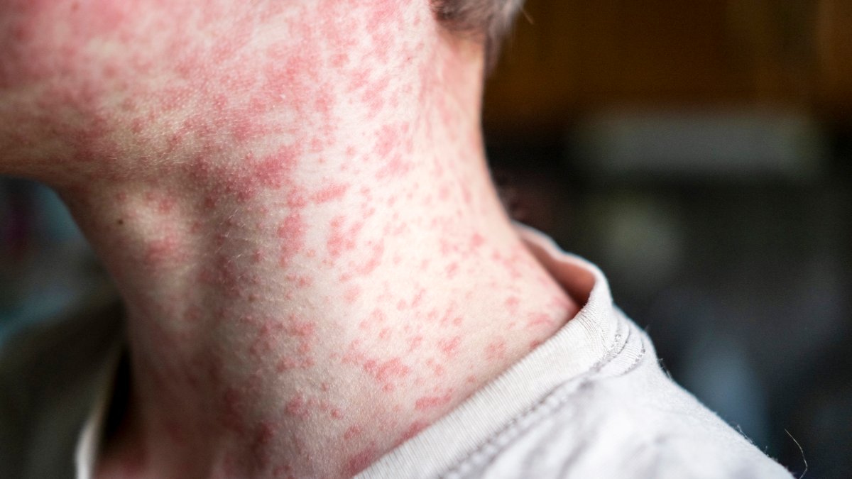 Delaware health officials warn of measles exposure in greater Rehoboth area