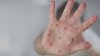 Health officials warn of possible measles exposure at Pennsylvania Target