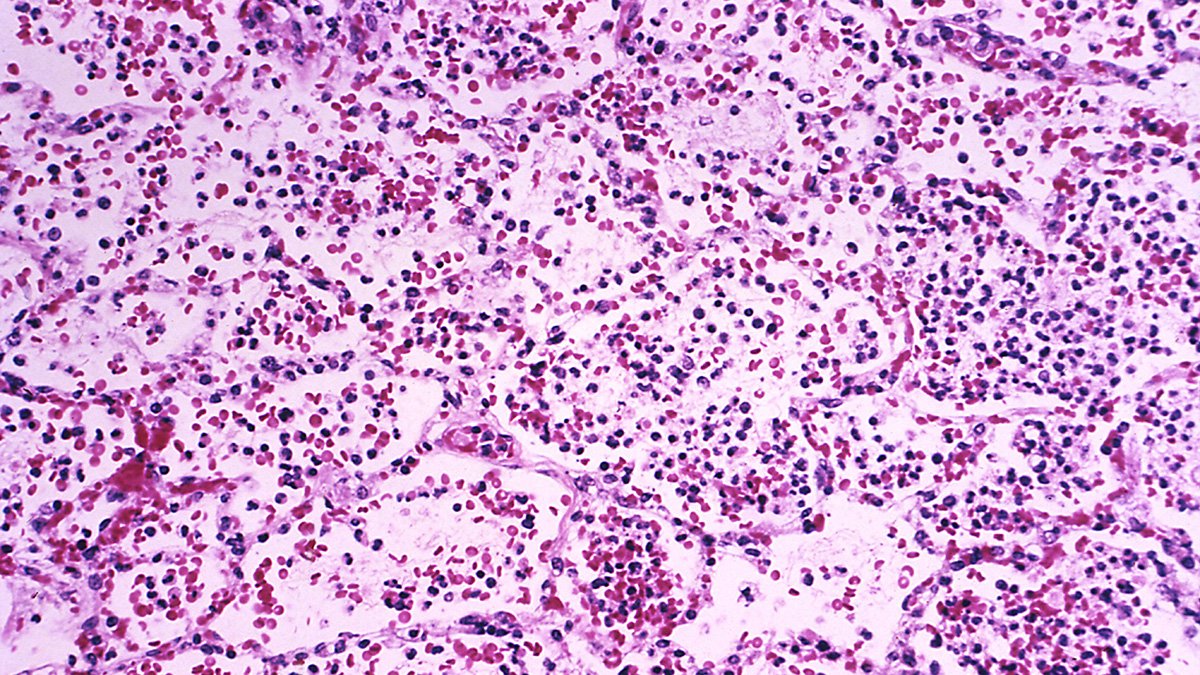 What to know about pneumonic plague after woman in Russia dies from mysterious illness